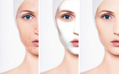 Set, female face with acne and bad skin, clean face after applying beauty mask.