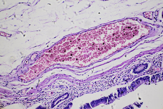 Intestinal adenomatosis