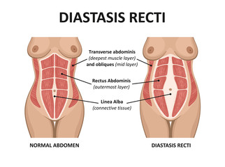 Diastasis recti. Abdominal muscle diastasis after pregnancy pregnancy and childbirth. - obrazy, fototapety, plakaty