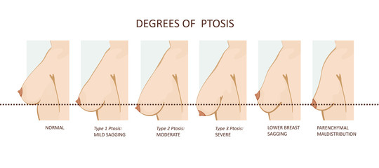Degrees of breast ptosis - obrazy, fototapety, plakaty