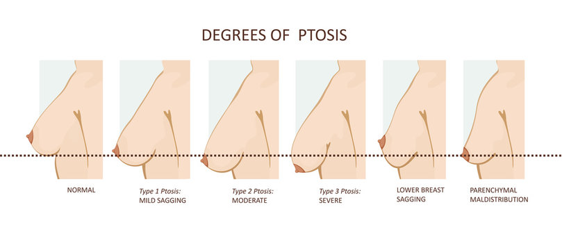 Degrees of breast ptosis