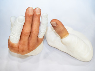 Prosthetic fingers Hand prosthesis. Amputation of the fingers. Layout prostheses. Hand injury Medical services.