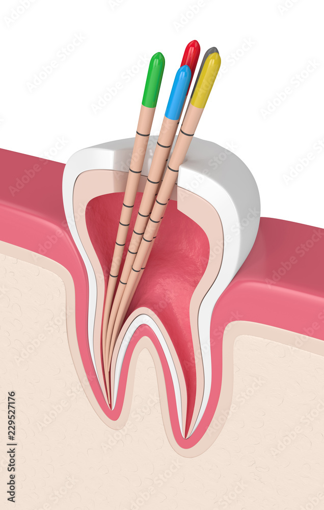 Fototapete 3d render of tooth in gums with gutta percha
