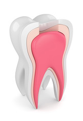 3d render of tooth with root canal treatment procedure