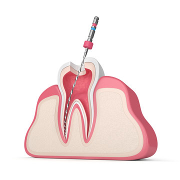 3d Render Of Tooth With Endodontic File In Gums