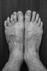 Fototapeta premium onychomycosis with fungal nail infection two feet