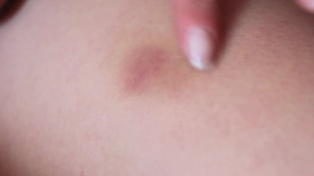girl's hand smears bruise ointment