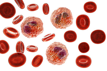 Eosinophilia, blood smear showing multiple eosinophils surround by red blood cells, 3D illustration. Eosinophilia occurs in parasitic and fungal infections, allergies, autoimmune disorders, tumors