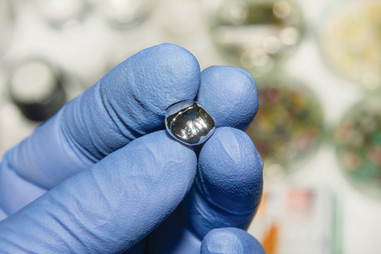 two chewing side teeth of the upper jaw after treatment of caries. Restoration of the chewing surface with a photopolymer filling material using the Rubber Dam system