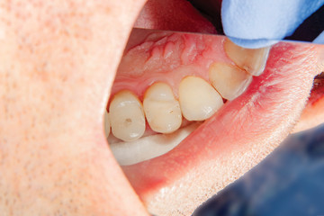 two chewing side teeth of the upper jaw after treatment of caries. Restoration of the chewing...