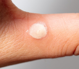 Hydrogen peroxide on corn on the skin