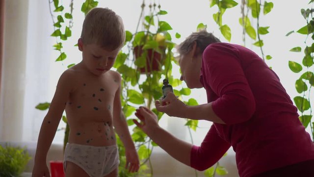 chicken pox in a little boy - a woman treats a child at home for chickenpox - handheld shoot