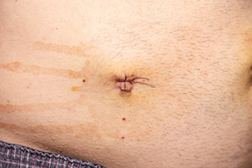 The abdomen with medical stitches after surgery by laparoscopy. Man's belly after laparoscopy. Metal staples.