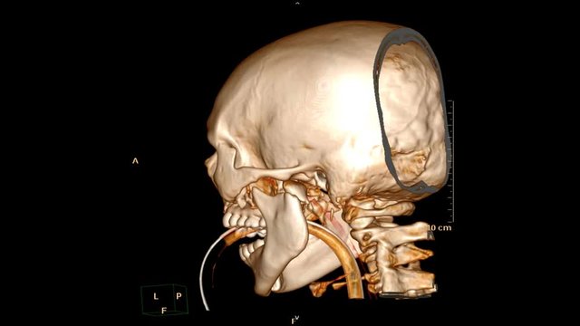 CT SCAN of Skull / facial Bone patient trauma case  with endotracheal tube Rotating on the monitor . Medical technology concept.