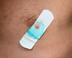 Bactericidal adhesive tape on the male nipple. Dressing after surgery on the nipple areola.