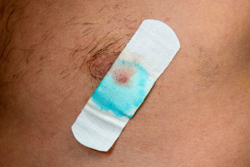 Bactericidal adhesive tape on the male nipple. Dressing after surgery on the nipple areola.