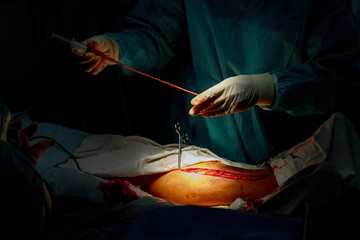 Surgery for Coronary Artery Bypass Grafting operation in the operating room