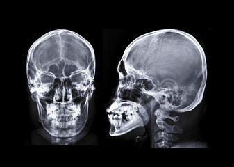 Human Skull X-ray images AP and Lateral View isolated on Black Background