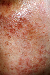Fototapeta premium Pigmented spots on the face. Pigmentation on cheeks