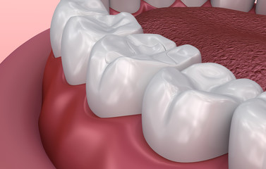 Fissure dental fillings, Medically accurate 3D illustration