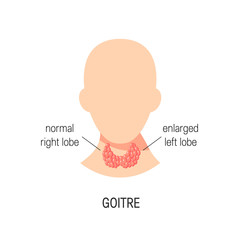 Goitre disease vector