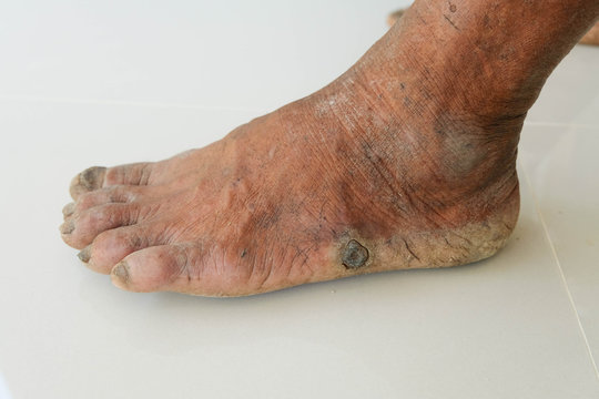 Diabetes foot and Side effects of the disease