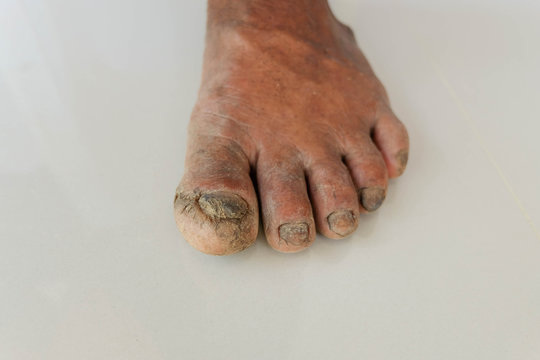 Diabetes foot and Side effects of the disease