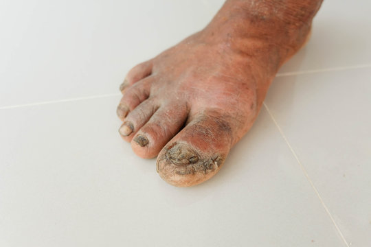Diabetes foot and Side effects of the disease