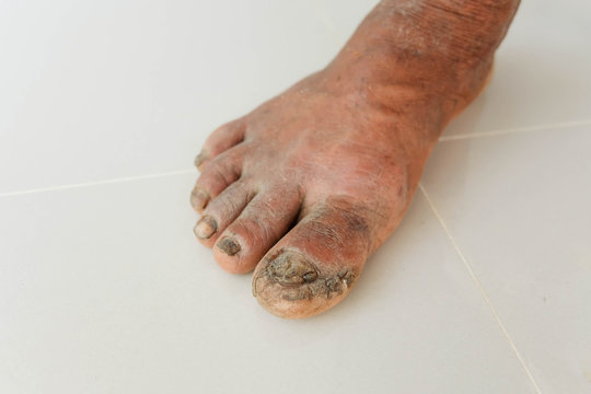 Diabetes foot and Side effects of the disease