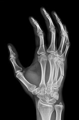 X-ray of fracture of metacarpal bone