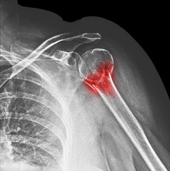 X-ray fracture of the surgical neck of the humerus