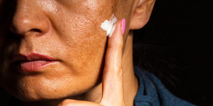 Pigmented spots on the face