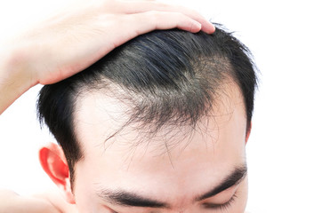 Fototapeta premium Young man serious hair loss problem for health care medical and shampoo product concept