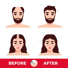 Hair Transplantation Before And After