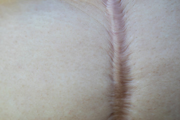 Closeup of woman body after he had surgery on his stomach. Abdominal injuries.selective focus