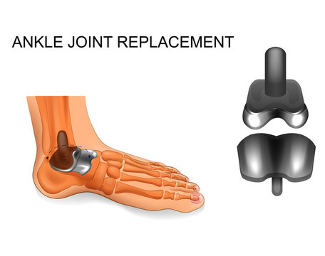 foot skeleton. ankle replacement