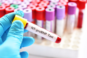 Blood sample for N-terminal pro B-type natriuretic peptide or NT-proBNP test, cardiac marker for acute or chronic heart failure
