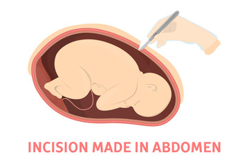 Incision making stage of birth via cesarean section