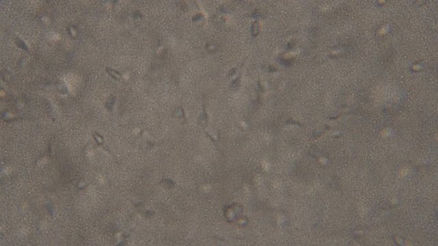 Sperm (spermatozoa) viewed under the microscope. Moving human sperm under Phase contrast Microscope, medium magnification,