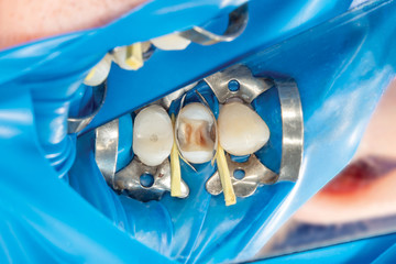 two chewing side teeth of the upper jaw after treatment of caries. Restoration of the chewing surface with a photopolymer filling material using the Rubber Dam system © Сергей Кучугурный