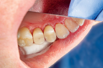 Obraz premium two chewing side teeth of the upper jaw after treatment of caries. Restoration of the chewing surface with a photopolymer filling material using the Rubber Dam system