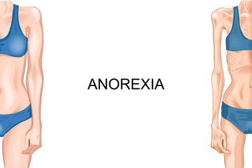 female figure with anorexia