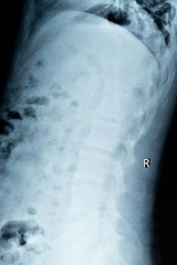 X-rays of lumbar mild hyperosteogeny