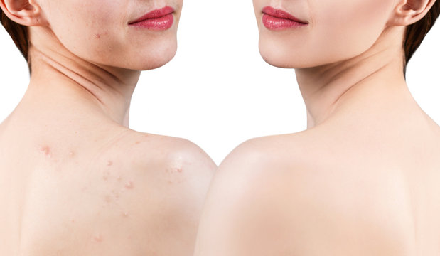 Young woman with acne on shoulders before and after treatment.
