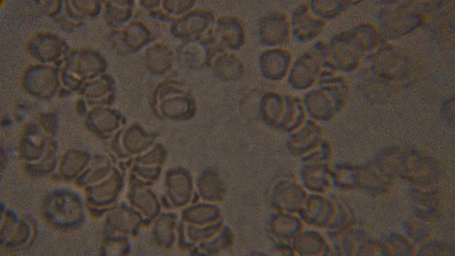 Blood, diseases, interstitial fluid, bacterial background, research using a microscope at extreme magnification of about.
