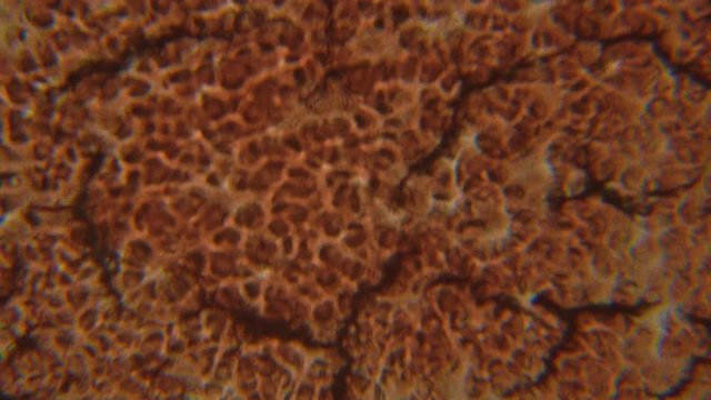 Alcoholic blood under the microscope. Blood clots in a drunk person.