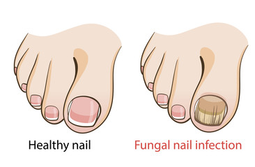 Nail fungal infection

