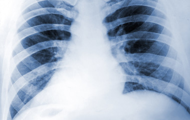 X Ray or Fluorogram of Human Thorax   - Medical Tuberculosis Diagnostic Test - Xray, MRI, CT Scan Film
