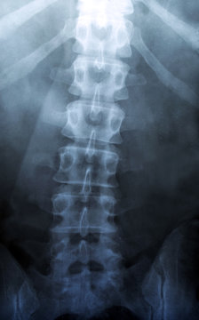 X Ray of Backbone - Human Skeleton Medical Scoliosis or Osteochondrosis Diagnostic Test - Xray, MRI, CT Scan Snapshot
