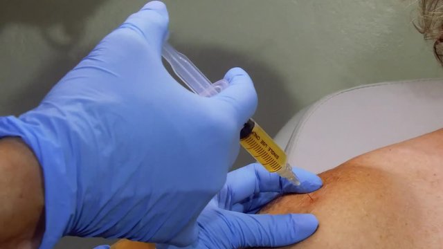 Platelet Rich Plasma Shoulder Injection